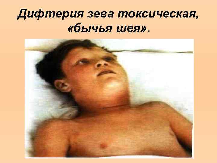 Дифтерия зева токсическая, «бычья шея» . 