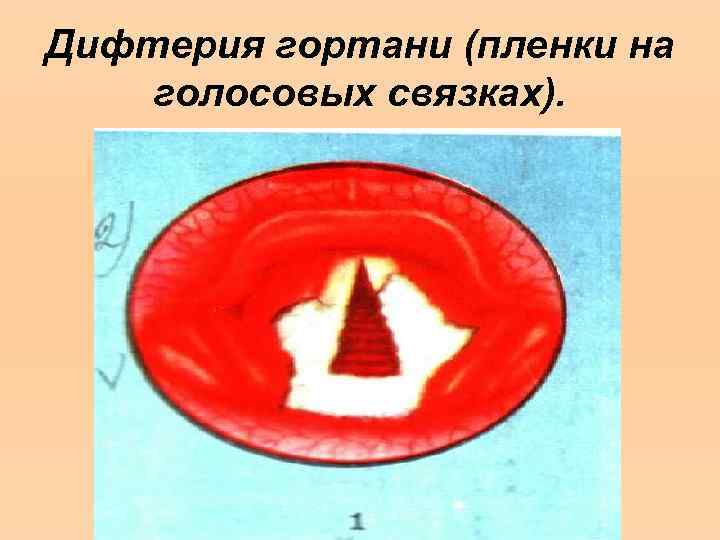 Дифтерия гортани (пленки на голосовых связках). 