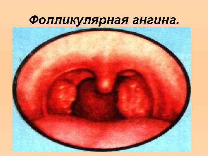 Фолликулярная ангина. 
