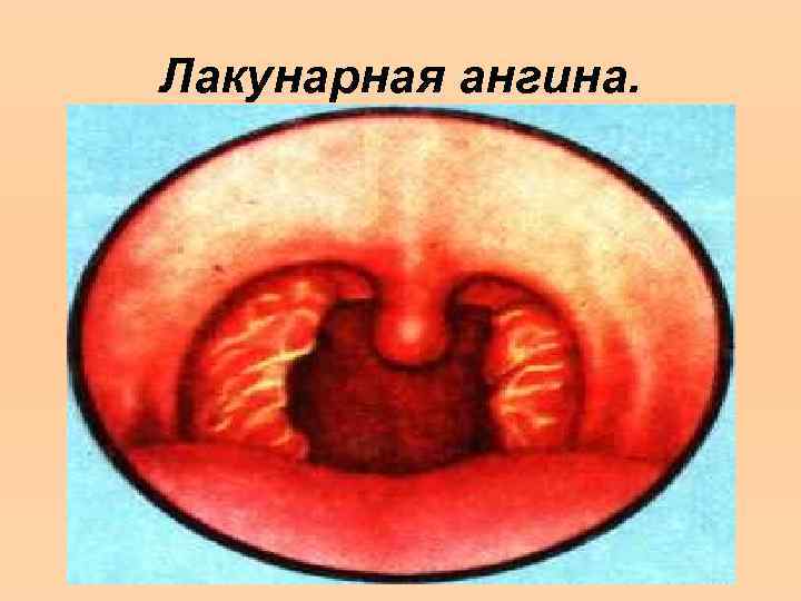 Лакунарная ангина. 