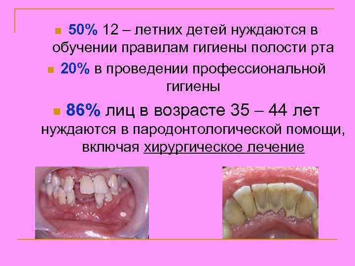 50% 12 – летних детей нуждаются в обучении правилам гигиены полости рта n 20%