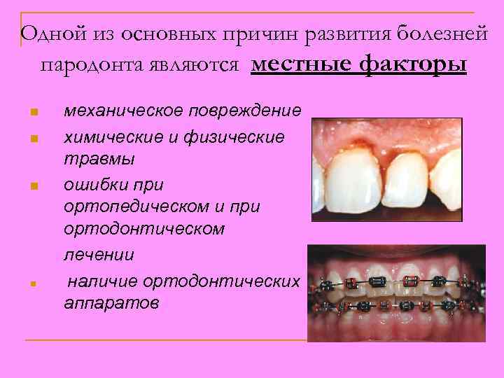 Одной из основных причин развития болезней пародонта являются местные факторы n n механическое повреждение