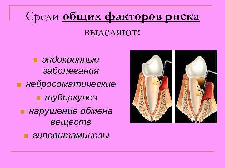 Среди общих факторов риска выделяют: эндокринные заболевания n нейросоматические n туберкулез n нарушение обмена