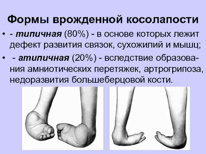 Формы врожденной косолапости • - типичная (80%) - в основе которых лежит дефект развития