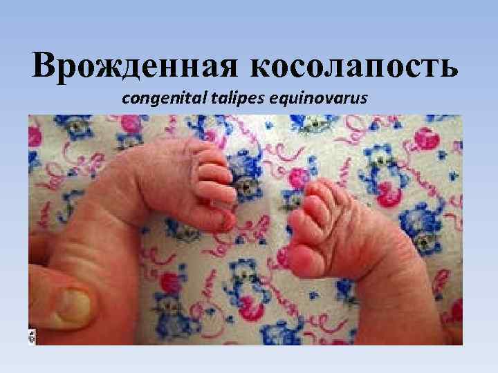 Врожденная косолапость congenital talipes equinovarus 