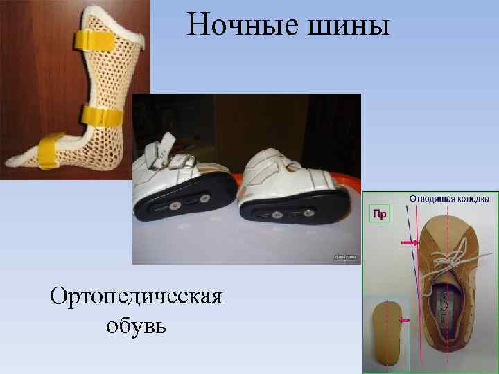 Ночные шины Ортопедическая обувь 