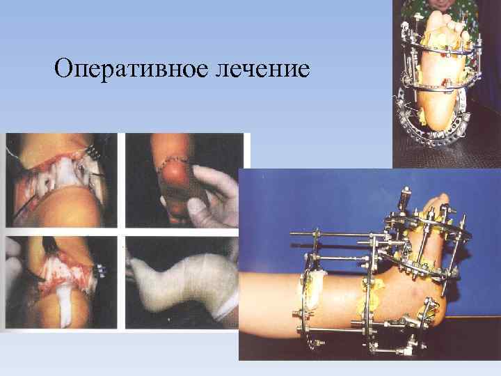 Оперативное лечение 