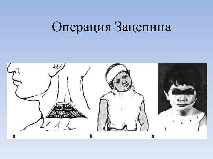Операция Зацепина 
