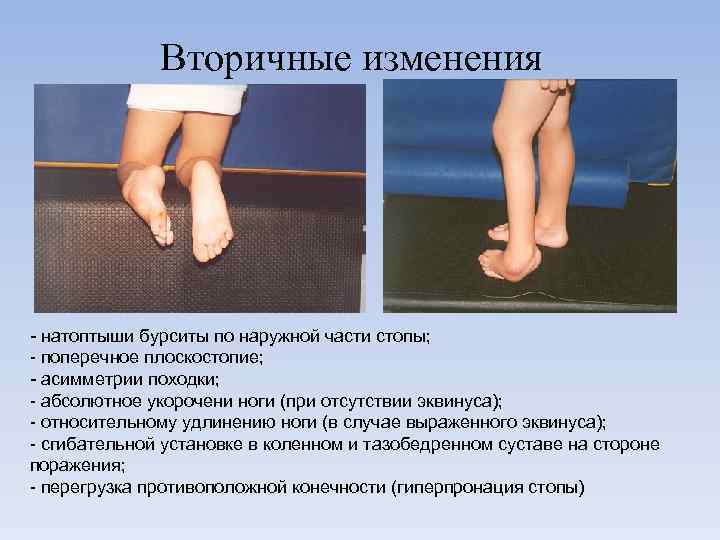 Вторичные изменения - натоптыши бурситы по наружной части стопы; - поперечное плоскостопие; - асимметрии