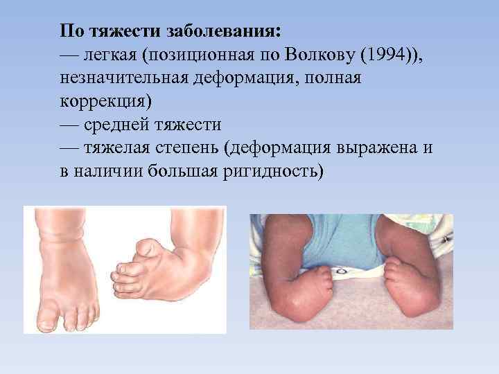 По тяжести заболевания: — легкая (позиционная по Волкову (1994)), незначительная деформация, полная коррекция) —