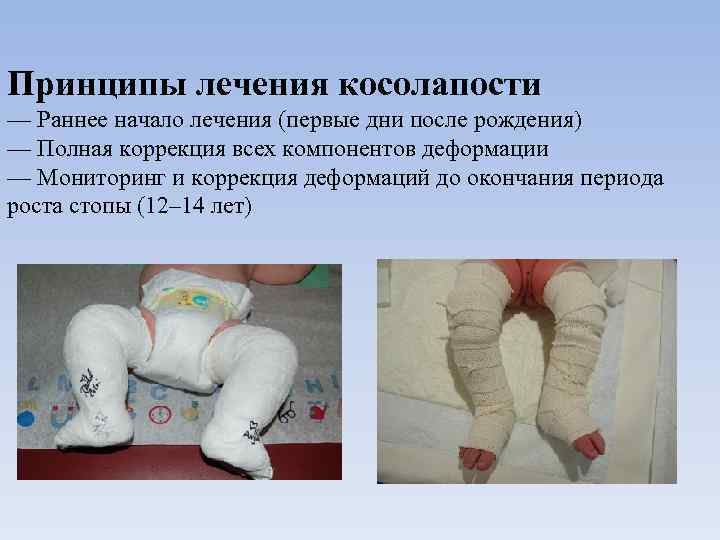 Принципы лечения косолапости — Раннее начало лечения (первые дни после рождения) — Полная коррекция