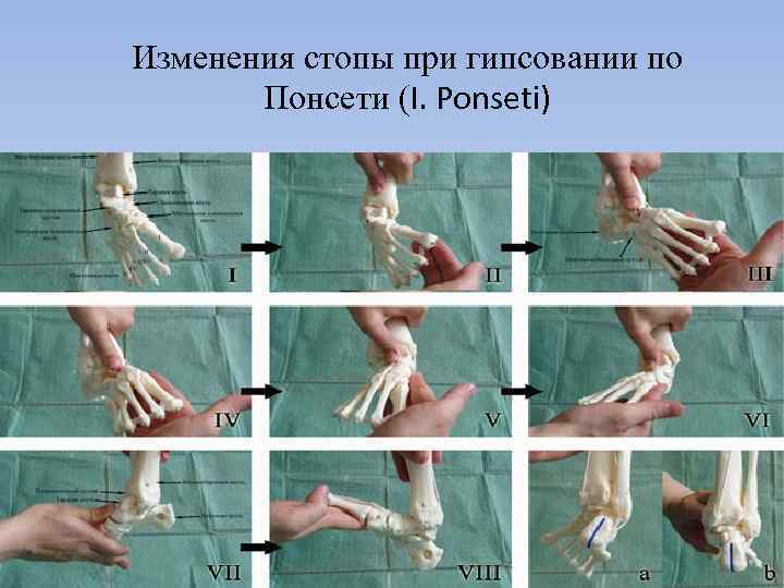 Изменения стопы при гипсовании по Понсети (I. Ponseti) 