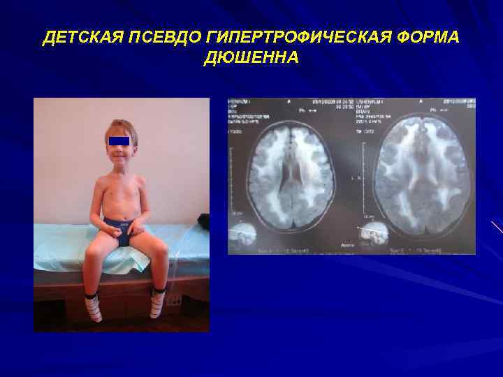 ДЕТСКАЯ ПСЕВДО ГИПЕРТРОФИЧЕСКАЯ ФОРМА ДЮШЕННА 