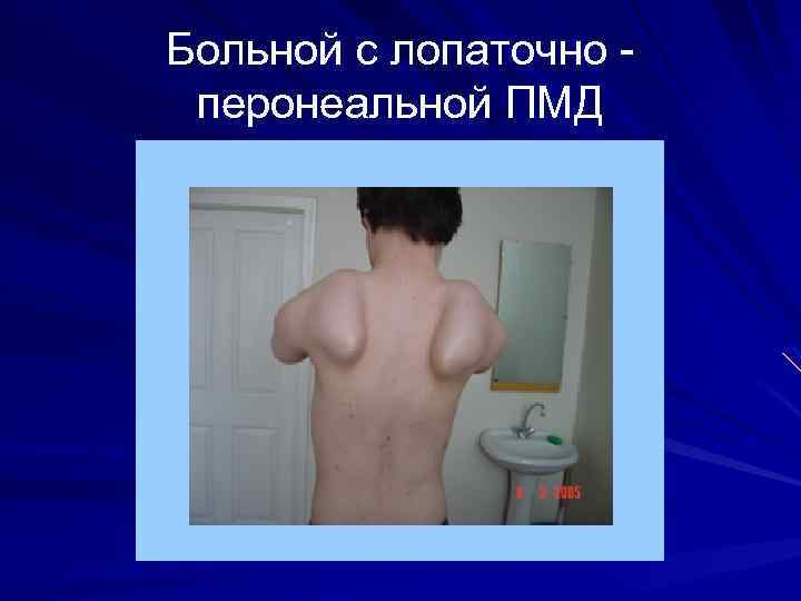 Больной с лопаточно перонеальной ПМД 