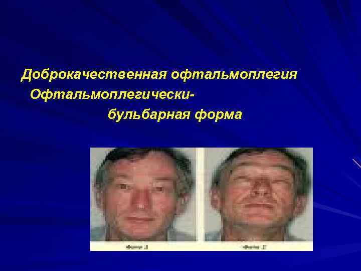 Доброкачественная офтальмоплегия Офтальмоплегически бульбарная форма 