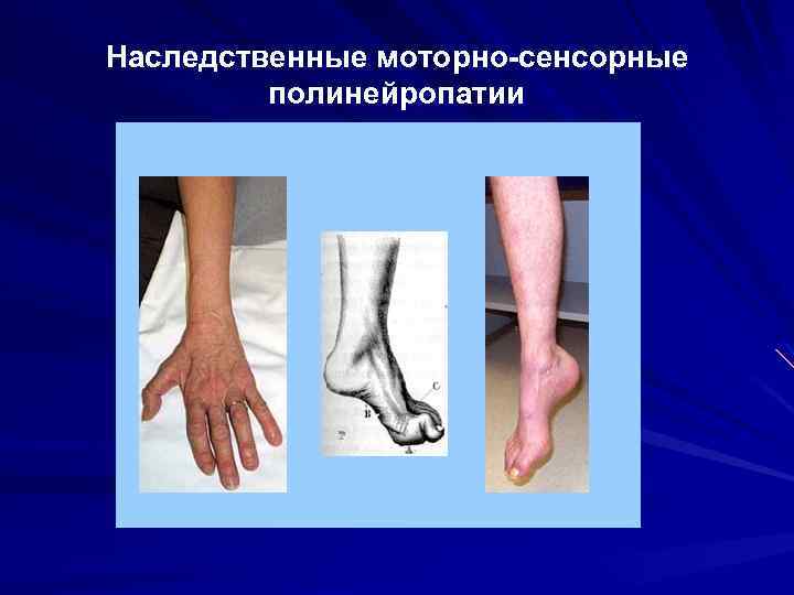 Наследственные моторно-сенсорные полинейропатии 