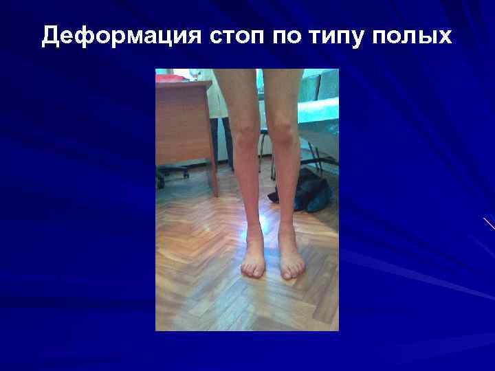 Деформация стоп по типу полых 