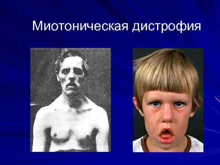 Миотоническая дистрофия 