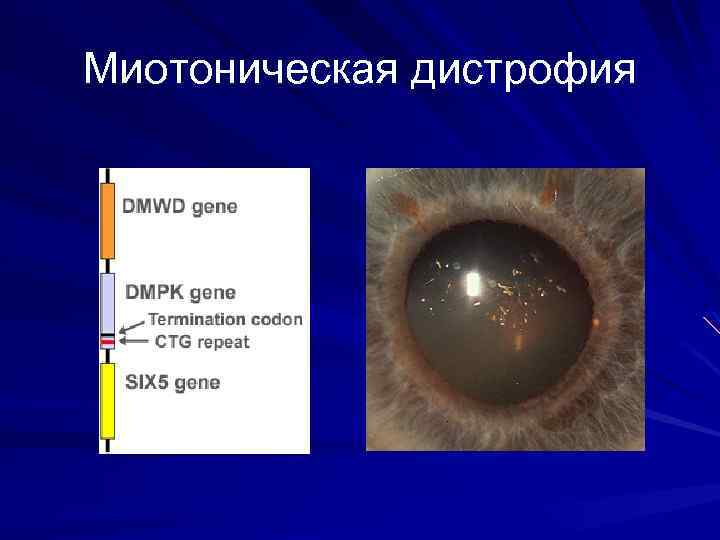 Миотоническая дистрофия презентация