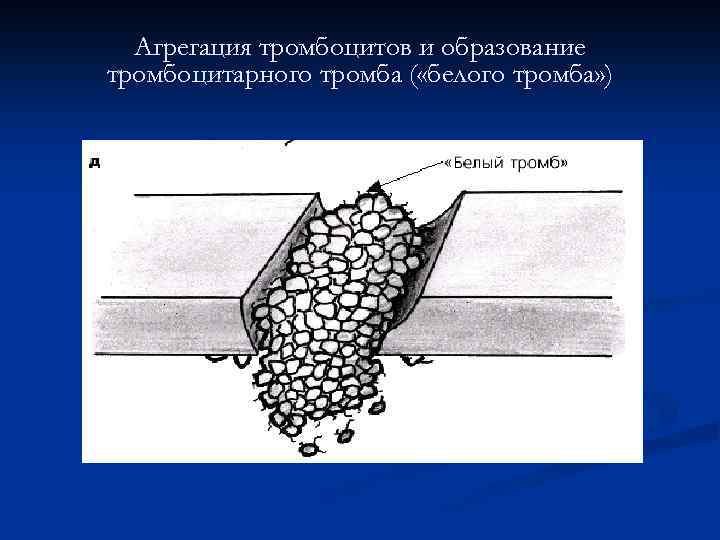 Агрегация тромбоцитов и образование тромбоцитарного тромба ( «белого тромба» ) 