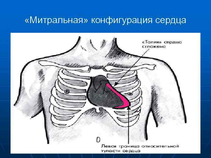  «Митральная» конфигурация сердца 