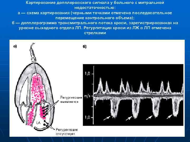 Картирование допплеровского сигнала у больного с митральной недостаточностью: а — схема картирования (черными точками