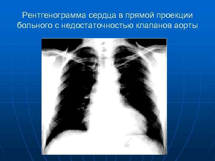 Рентгенограмма сердца в прямой проекции больного с недостаточностью клапанов аорты 