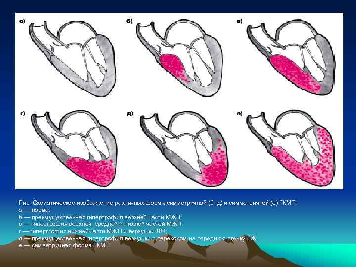 Рис. Схематическое изображение различных форм асимметричной (б–д) и симметричной (е) ГКМП: а — норма;
