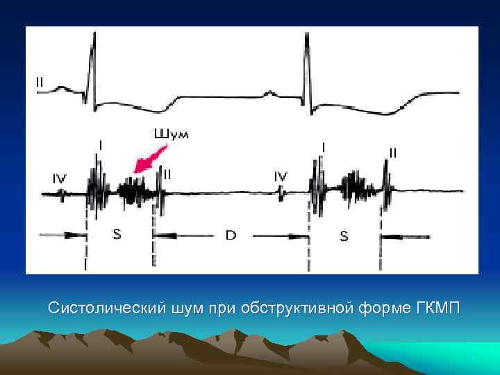  Систолический шум при обструктивной форме ГКМП 
