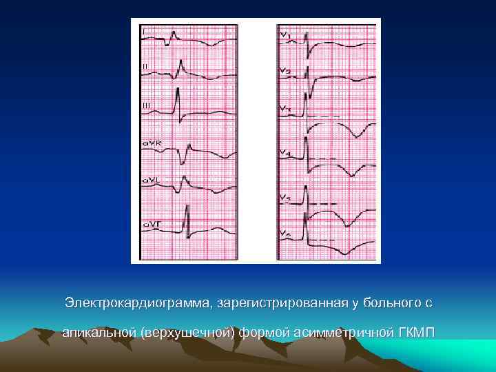 Электрокардиограмма, зарегистрированная у больного с апикальной (верхушечной) формой асимметричной ГКМП 