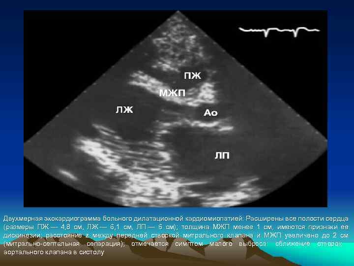 Двухмерная эхокардиограмма больного дилатационной кардиомиопатией: Расширены все полости сердца (размеры ПЖ — 4, 8