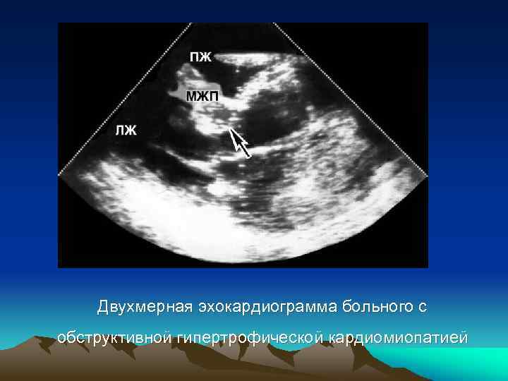 Двухмерная эхокардиограмма больного с обструктивной гипертрофической кардиомиопатией 