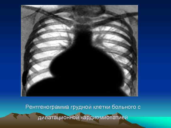 Рентгенограмма грудной клетки больного с дилатационной кардиомиопатией 