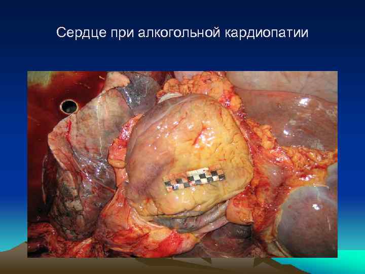 Сердце при алкогольной кардиопатии 