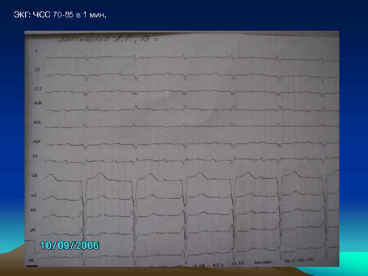 ЭКГ: ЧСС 70 -85 в 1 мин, 