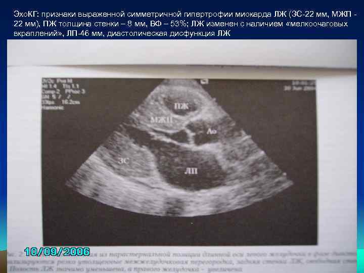 Эхо. КГ: признаки выраженной симметричной гипертрофии миокарда ЛЖ (ЗС-22 мм, МЖП 22 мм), ПЖ