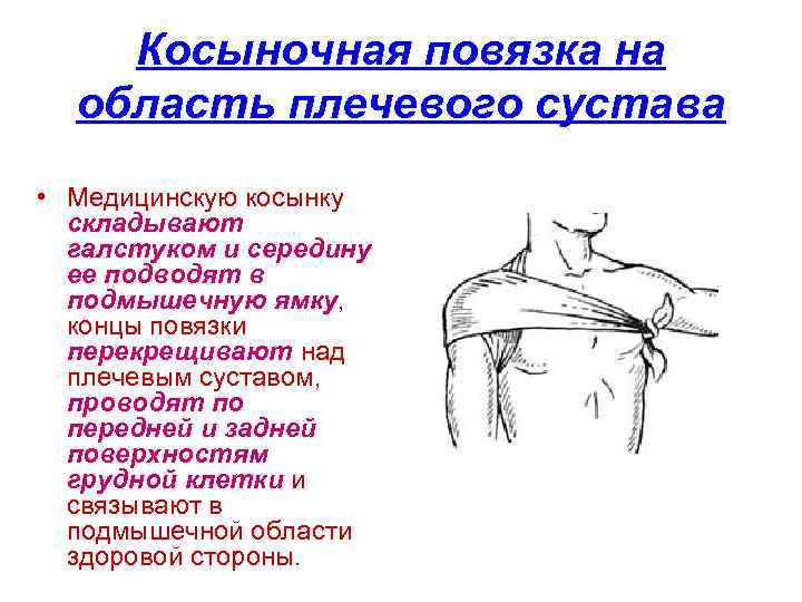 Косыночная повязка на область плечевого сустава • Медицинскую косынку складывают галстуком и середину ее