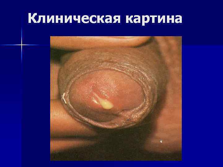 Клиническая картина 