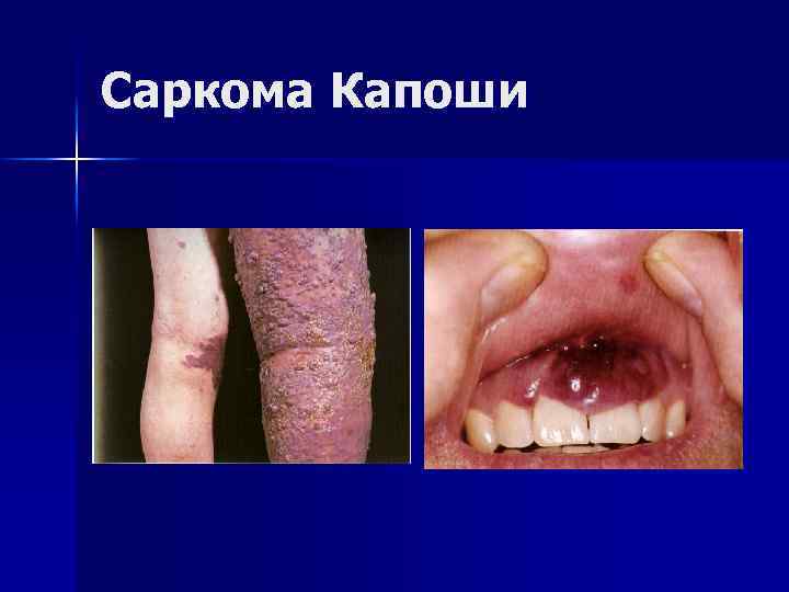 Саркома Капоши 