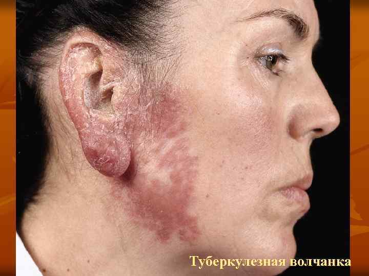 Туберкулезная волчанка 