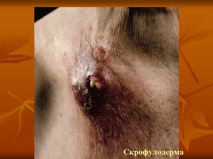 Скрофулодерма 