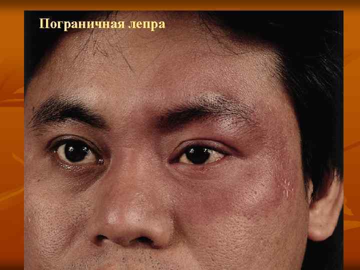 Пограничная лепра 