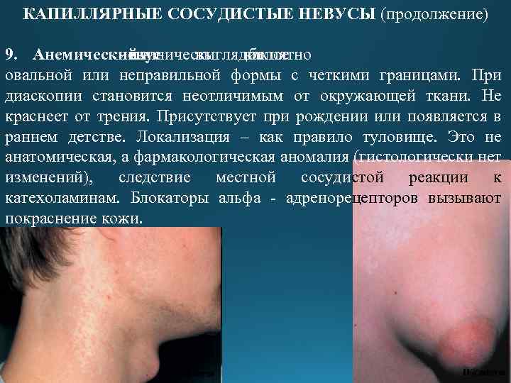 КАПИЛЛЯРНЫЕ СОСУДИСТЫЕ НЕВУСЫ (продолжение) 9. Анемический – невус клинически выглядит пятно как белое овальной