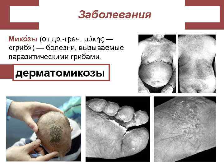 Заболевания Мико зы (от др. -греч. μύκης — «гриб» ) — болезни, вызываемые паразитическими
