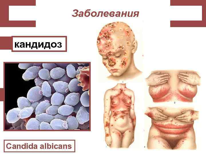 Заболевания кандидоз Candida albicans 