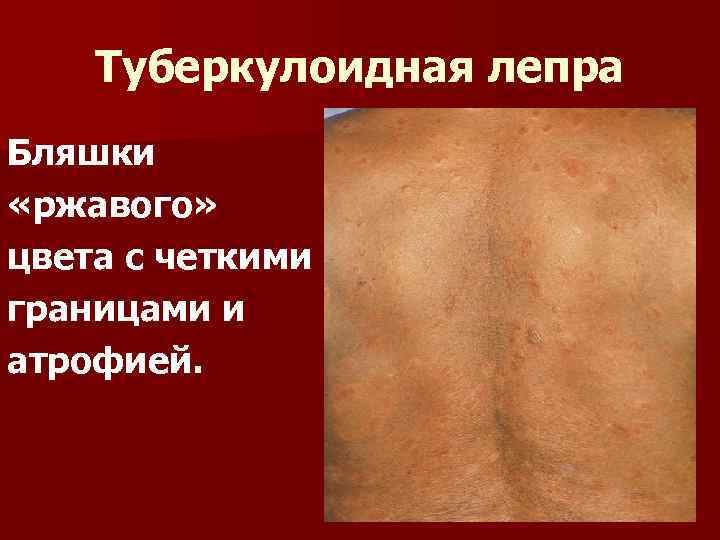 Туберкулоидная лепра Бляшки «ржавого» цвета с четкими границами и атрофией. 