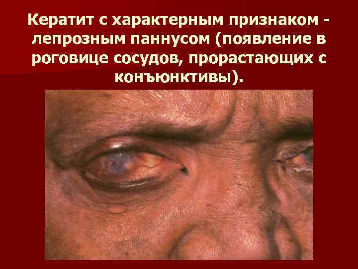 Кератит с характерным признаком лепрозным паннусом (появление в роговице сосудов, прорастающих с конъюнктивы). 