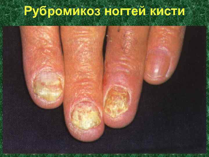 Рубромикоз ногтей кисти 