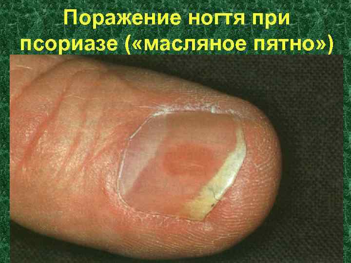 Поражение ногтя при псориазе ( «масляное пятно» ) 