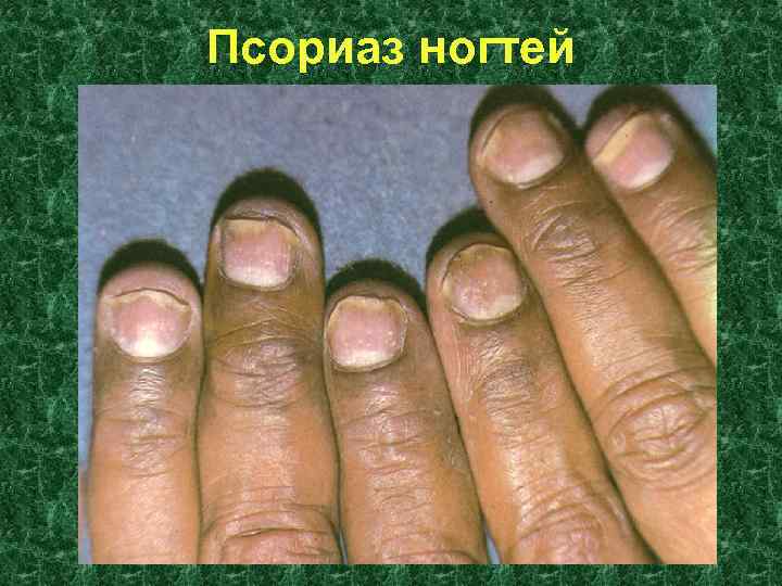 Псориаз ногтей 